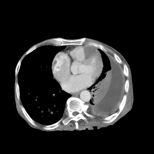 Aggressive lung cancer with cardiac metastases, pulmonary artery tumor thrombus, and Budd-Chiari (Radiopaedia 60320-67981 A 37).jpg