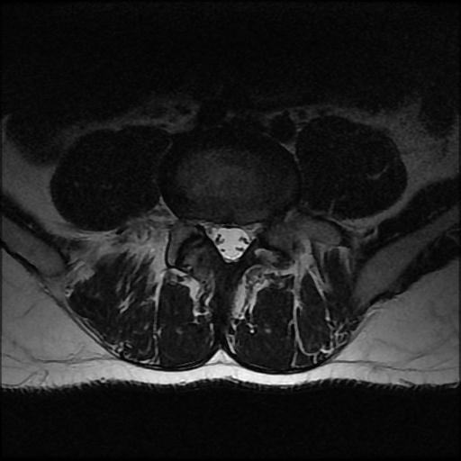 File:Aggressive vertebral hemangioma with pathological fracture (Radiopaedia 69528-79411 Axial T2 4).jpg