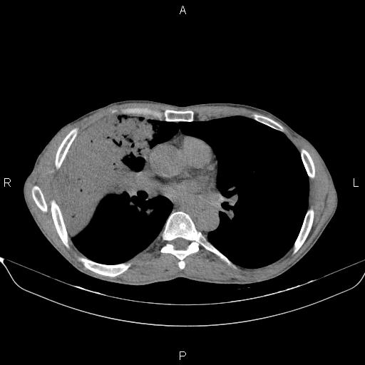 Air bronchogram in pneumonia (Radiopaedia 85719-101512 Axial non-contrast 35).jpg