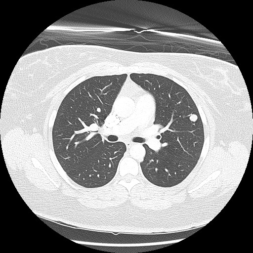 Alveolar soft part sarcoma - right leg (Radiopaedia 59432-67091 Axial lung window 47).jpg
