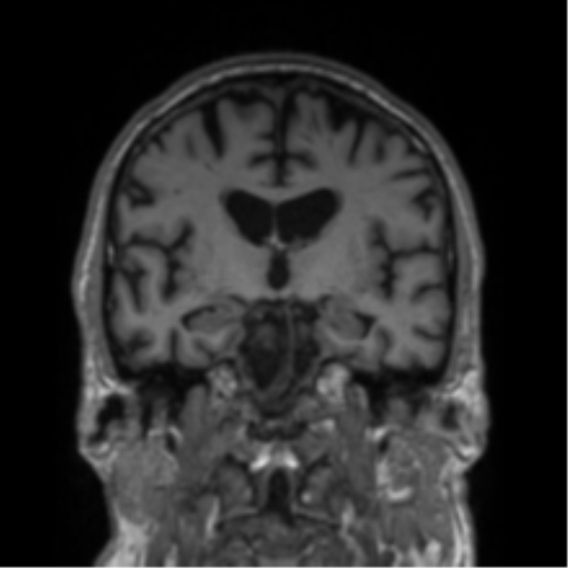 File:Alzheimer's disease- with Gerstmann syndrome and dressing apraxia (Radiopaedia 54882-61150 Coronal T1 48).png