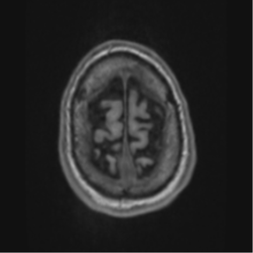 Alzheimer's disease- with apraxia (Radiopaedia 54763-61011 Axial T1 69).png