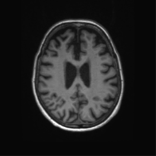 Alzheimer's disease (Radiopaedia 42658-45802 Axial T1 57).png