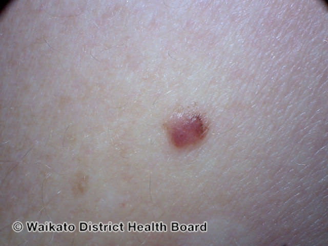 File:Amelanotic melanoma (DermNet NZ amelanotic-melanoma-032).jpg