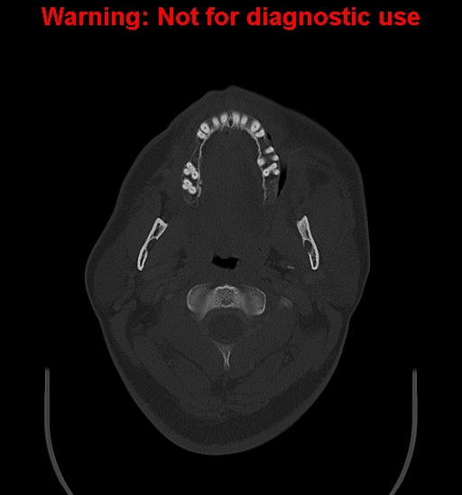 Ameloblastoma (Radiopaedia 33126-34164 Axial bone window 7).jpg