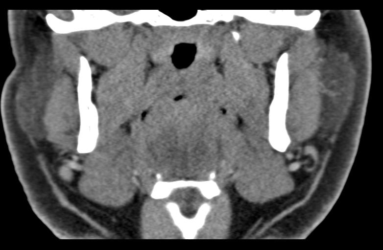 Ameloblastoma (Radiopaedia 33677-34806 Coronal non-contrast 35).png