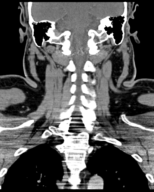 Ameloblastoma (Radiopaedia 38520-40623 Coronal non-contrast 52).png