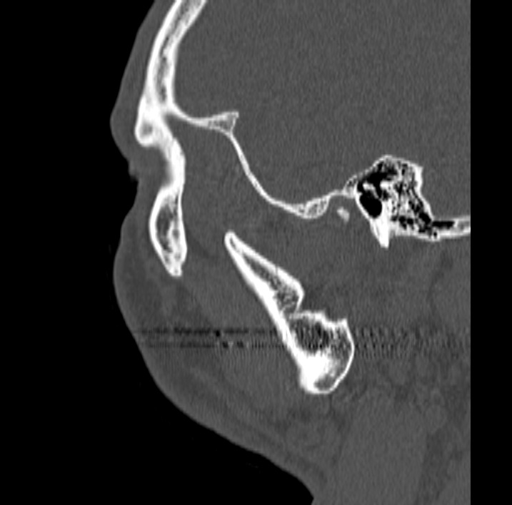 Ameloblastoma (Radiopaedia 77750-89997 Sagittal bone window 102).jpg