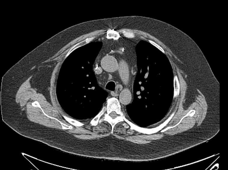 Amiodarone lung (Radiopaedia 62514-70769 Axial non-contrast 30).jpg