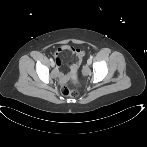 File:Amoebic liver abscess (Radiopaedia 52611-58530 A 87).png