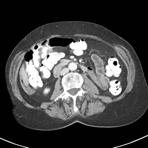 Ampullary adenocarcinoma (Radiopaedia 34013-35237 C 25).png