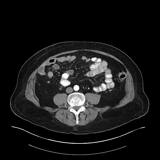 Ampullary adenocarcinoma (Radiopaedia 59373-66734 A 103).jpg