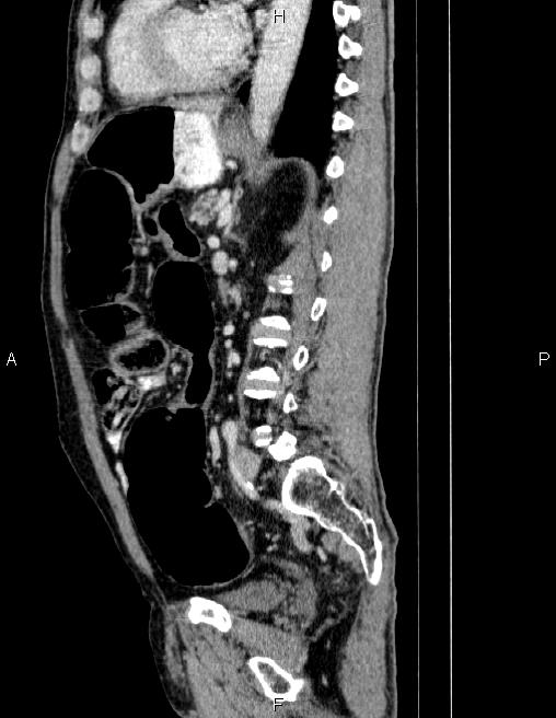 Ampullary adenocarcinoma (Radiopaedia 86093-102032 D 60).jpg