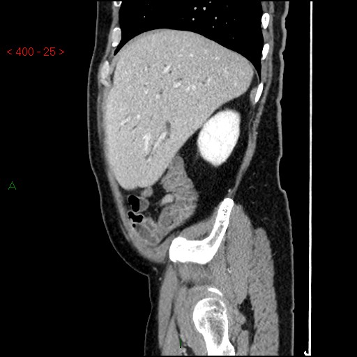 Ampullary carcinoma (Radiopaedia 56396-63056 D 24).jpg