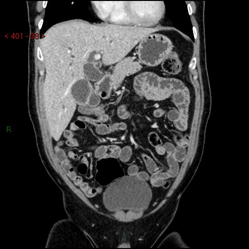 Ampullary carcinoma (Radiopaedia 56396-63056 E 37).jpg