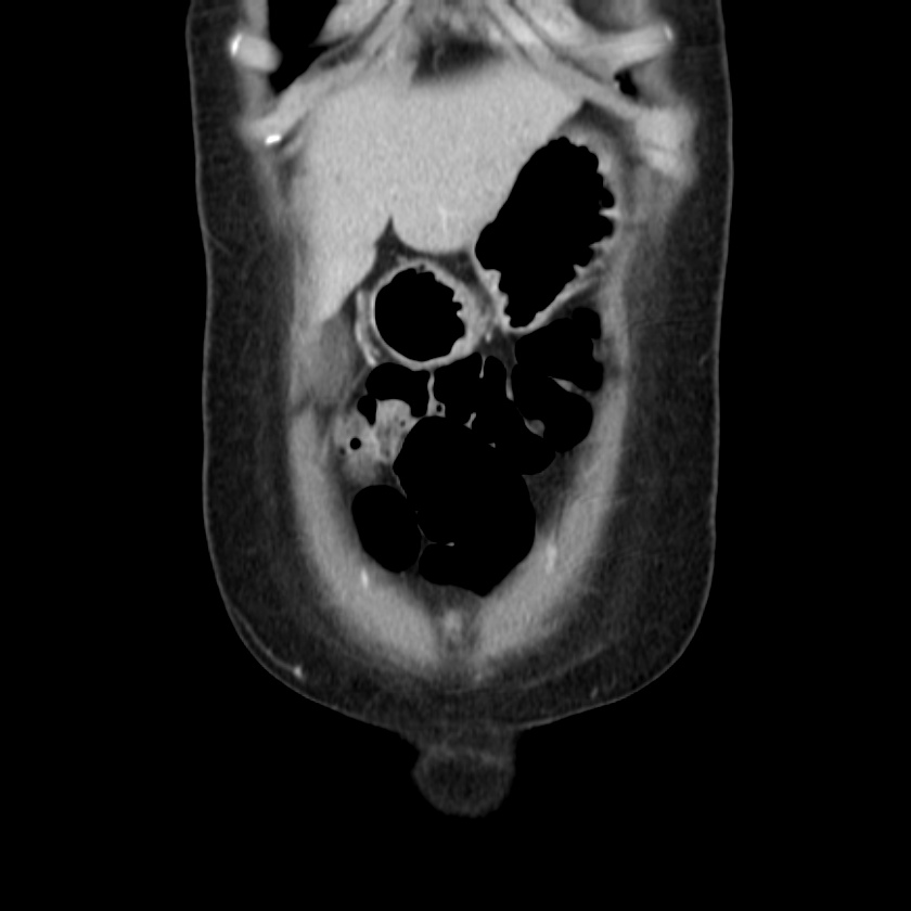 Ampullary tumor (Radiopaedia 22787-22816 E 10).jpg