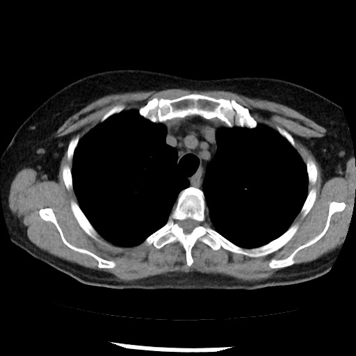 File:Amyloidosis - bronchial and diffuse nodular pulmonary involvement (Radiopaedia 60156-67744 Axial non-contrast 15).jpg