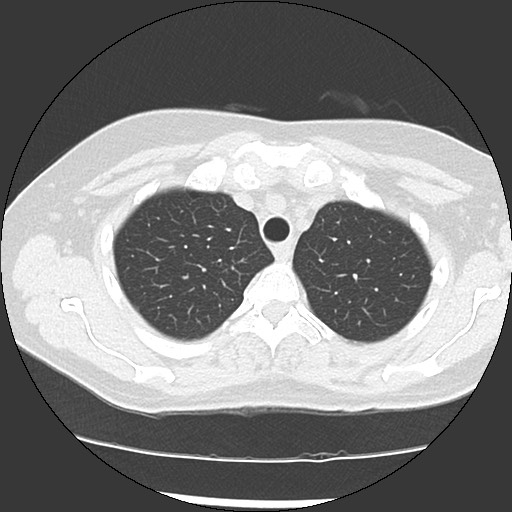 File:Amyloidosis - bronchial and diffuse nodular pulmonary involvement (Radiopaedia 60156-67744 B 12).jpg