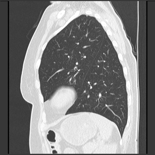 Amyloidosis - bronchial and diffuse nodular pulmonary involvement (Radiopaedia 60156-67744 F 42).jpg