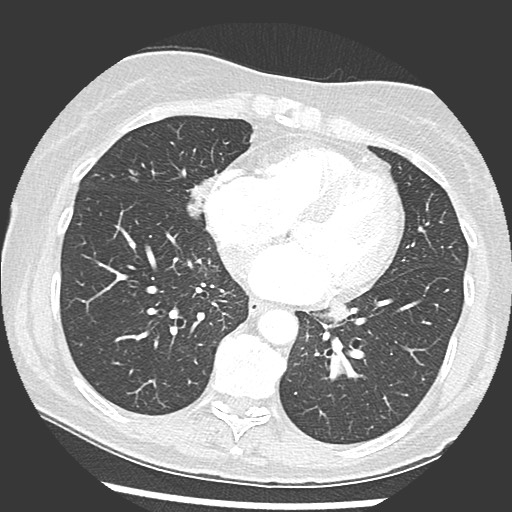 File:Amyloidosis - bronchial and diffuse nodular pulmonary involvement (Radiopaedia 60156-67745 Axial lung window 55).jpg