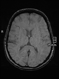 Amyotrophic lateral sclerosis (Radiopaedia 70821-81017 Axial SWI 29).jpg