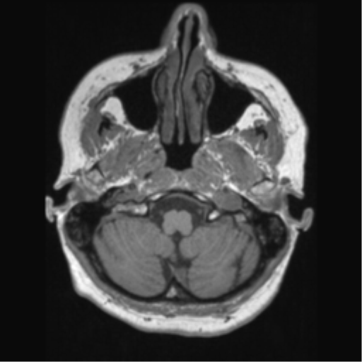 Anaplastic astrocytoma IDH wild-type (pseudoprogression) (Radiopaedia 42209-45276 Axial T1 28).png