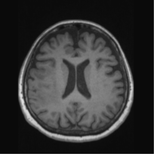 Anaplastic astrocytoma IDH wild-type (pseudoprogression) (Radiopaedia 42209-45276 Axial T1 94).png