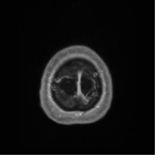 Anaplastic astrocytoma IDH wild-type (pseudoprogression) (Radiopaedia 42209-45276 Axial T1 C+ 141).png