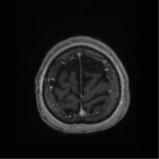 Anaplastic astrocytoma IDH wild-type (pseudoprogression) (Radiopaedia 42209-45277 Axial T1 C+ 115).png
