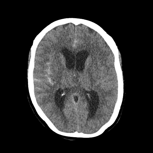 Aneursym related subarachnoid hemorrhage with hydrocephalus (Radiopaedia 45105-49083 Axial non-contrast 26).jpg