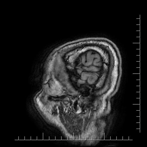 File:Aneurysm of posterior communicating artery (Radiopaedia 20188-20163 Sagittal T1 67).jpg