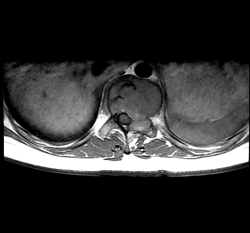 File:Aneurysmal bone cyst (Radiopaedia 9419-10103 C 1).jpg