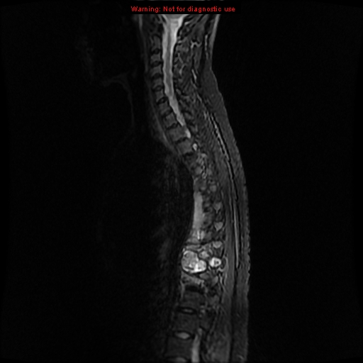 File:Aneurysmal bone cyst (Radiopaedia 9419-10103 Sagittal T2 8).jpg