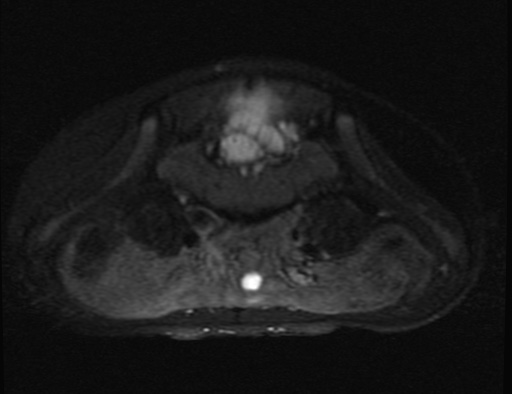 File:Aneurysmal bone cyst - sacrum (Radiopaedia 65190-74196 Axial T2 fat sat 4).jpg