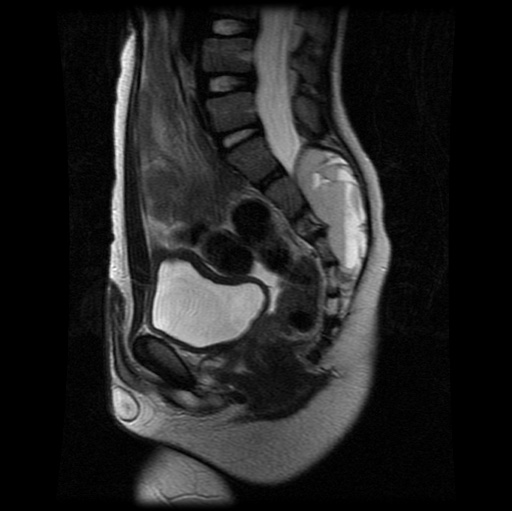 File:Aneurysmal bone cyst - sacrum (Radiopaedia 65190-74196 Sagittal T2 18).jpg