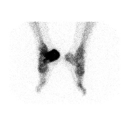 File:Aneurysmal bone cyst of the calcaneus (Radiopaedia 60669-68419 RPO 1).jpg