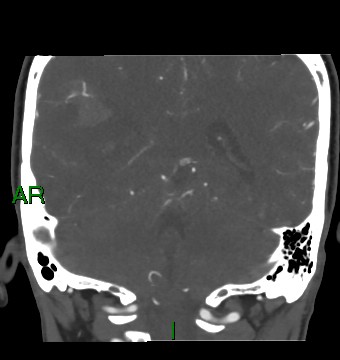Aneurysmal subarachnoid hemorrhage with intra-axial extension (Radiopaedia 84371-99732 C 37).jpg