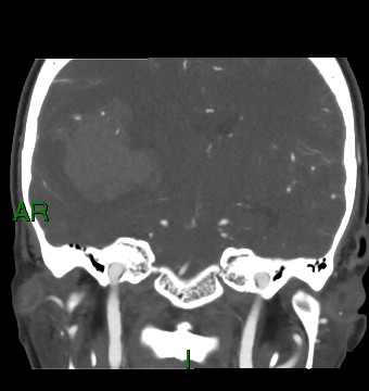 Aneurysmal subarachnoid hemorrhage with intra-axial extension (Radiopaedia 84371-99732 C 50).jpg