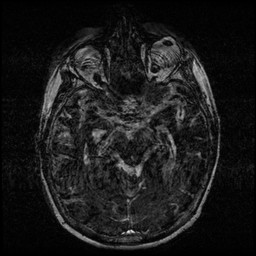 Angioinvasive aspergillosis in the pituitary fossa (Radiopaedia 39676-42010 Ax 3D FIESTA VOLUME 69).png