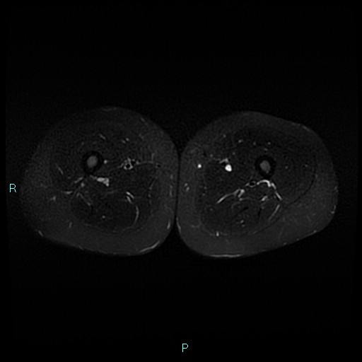 Angioleiomyoma (Radiopaedia 85442-101078 Axial STIR 47).jpg