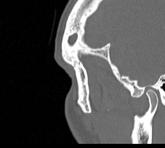 Angular epidermoid cyst (Radiopaedia 46908-51439 Sagittal bone window 92).png