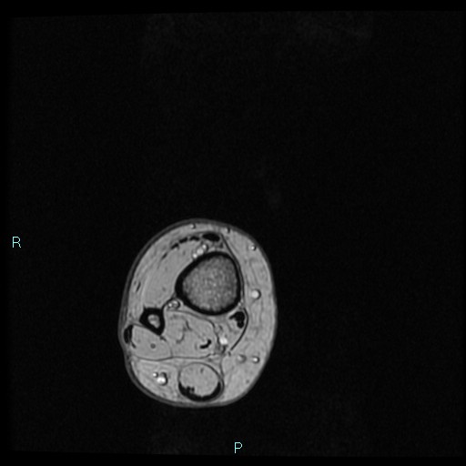 Ankle ganglion cyst (Radiopaedia 62809-71162 Axial Gradient Echo 104).jpg