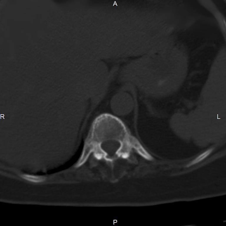 Ankylosing spondylitis (Radiopaedia 8748-9556 Axial bone window 10).jpg