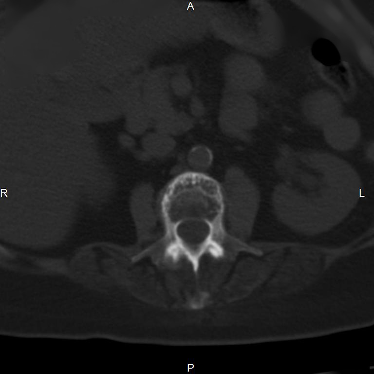 Ankylosing spondylitis (Radiopaedia 8748-9556 Axial bone window 26).jpg