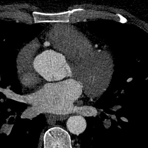 File:Anomalous origin of the left coronary artery with malignant course (Radiopaedia 77842-90126 C 80).jpeg