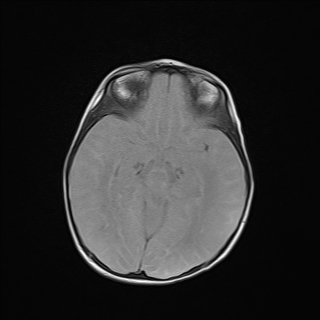File:Anoxic brain injury (Radiopaedia 79165-92139 Axial FLAIR 12).jpg