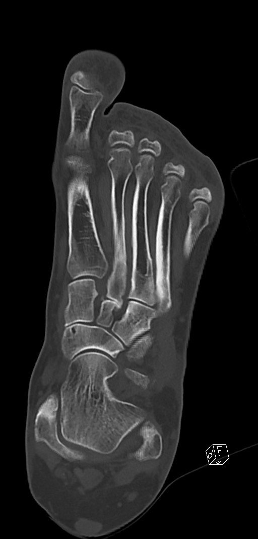 Anterior calcaneal process fracture (Radiopaedia 63353-71943 Coronal bone window 22).jpg