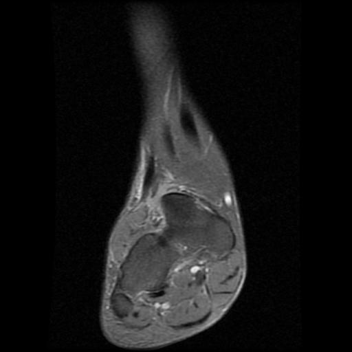 File:Anterior calcaneal process fracture (Radiopaedia 71377-81705 Coronal PD fat sat 2).jpg