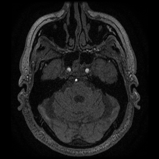 Anterior cerebral artery infarction (Radiopaedia 46794-51323 Axial MRA 36).jpg