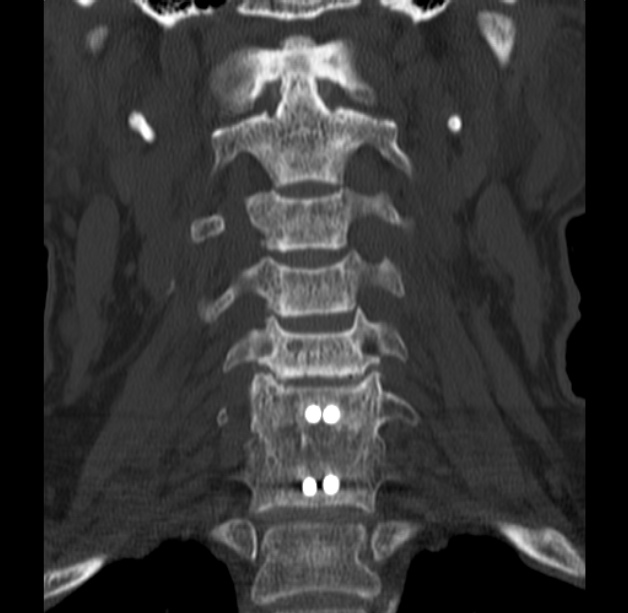 Anterior cervical postdiscectomy arthrodesis (Radiopaedia 32678-33646 Coronal bone window 21).jpg